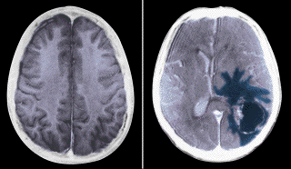 Brain scan of healthy brain (left) and brain tumor (shown in blue, right).