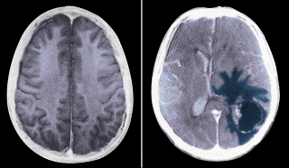 Brain Tumor Pictures