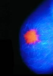 Breast cancer lump shown in a mammogram