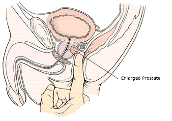 Milking The Prostate