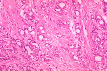 Histopathology of adenocarcinoma of the prostate.