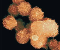 Tumor cells in prostate cancer.