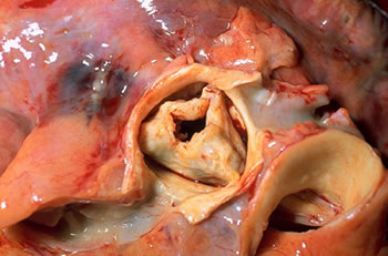 Thickened and fused leaflets in aortic valve stenosis.