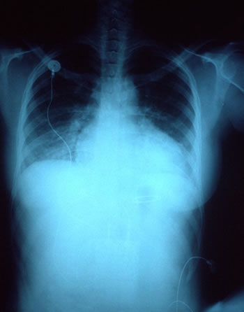 Enlarged cardiac sillhouette in congestive heart failure