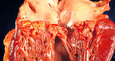 Subacute endocarditis