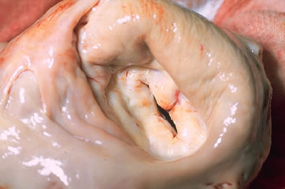 Thickened leaflets in mitral valve stenosis.