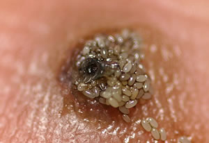 Eggs shed from the tungiasis lesion.