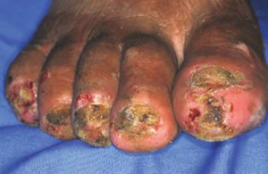 Tungiasis found in toes