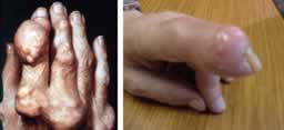 Gout in the hand and fingers