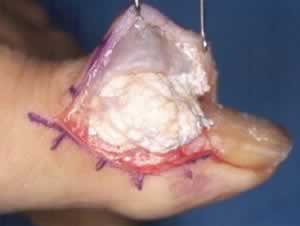 Gout surgery - removal of urate deposit.