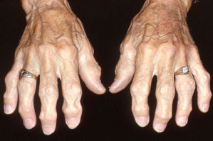Heberden and Bouchard nodes in an arthritic hand.