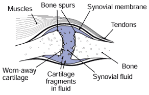 Joint with osteoarthritis