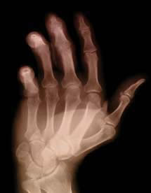 X-ray of osteoarthritis in the hand