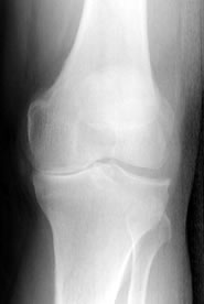 X-ray of osteoarthritis in the knee