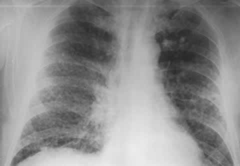 Silicosis - nodules on chest x-ray