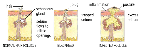 Normal hair follicle, blackhead, and infected follicle in acne