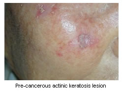 Pre-cancerous lesion of actinic keratosis