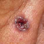 Basal cell carcinoma 1