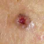 Basal cell carcinoma 2