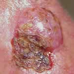 Basal cell carcinoma 3