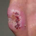 Basal cell skin cancer 4