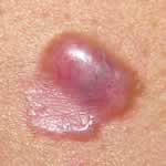Basal cell skin cancer 5