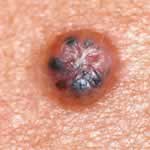 Basal cell skin cancer 6