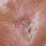 Basal cell carcinoma 7