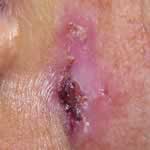 Basal cell carcinoma 8