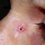 Basal cell carcinoma 9