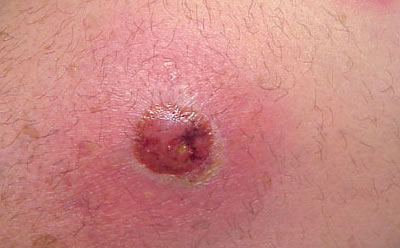 wart pus