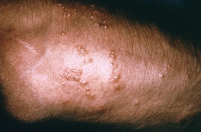 Irritant+contact+dermatitis+pictures