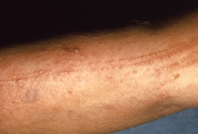 Irritant+contact+dermatitis+pictures