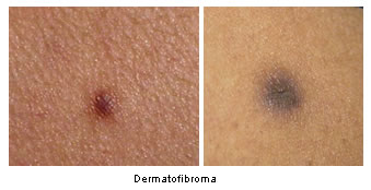 Dermatofibroma spots