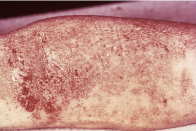 Eczema or atopic dermatitis