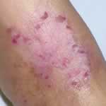 Atopic dermatitis in adult