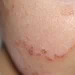 Infant atopic dermatitis