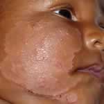 Infant atopic eczema