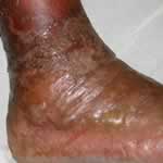 Erysipelas on the foot