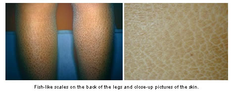 Fish-like scales on the back of the legs of ichthyosis patient.