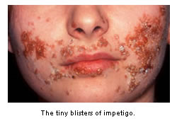 Tiny blisters of impetigo