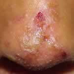 Impetigo on the nose 1