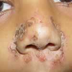 Impetigo on the nose 3