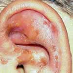 Impetigo on the earlobe