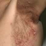 Impetigo infection on the armpit