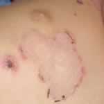 Infant impetigo infection 1