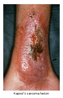 Leg lesion in Kaposi's sarcoma