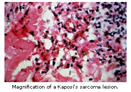 Red blood cell and homosiderin deposit in Kaposi's sarcoma lesion.