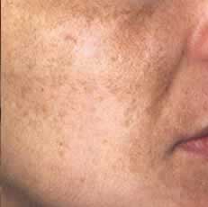 Melasma on the cheek