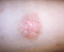 How long do pityriasis rosea symptoms last?